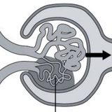 glomerulopathy | Unsorted